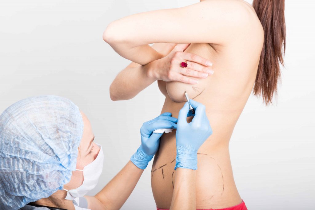 Alles, was Sie über Brustvergrößerung mit Implantaten wissen müssen